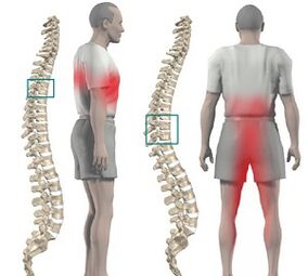 pain in the spine with thoracic osteochondrosis