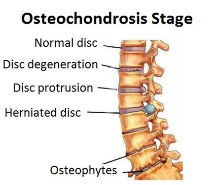 Level of osteochondrosis