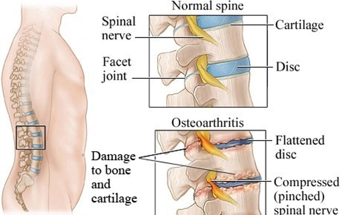 The difference between a healthy disc and a disc with osteochondrosis