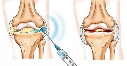 How to treat knee joint arthrosis