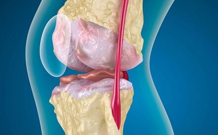 Reason -Secondary development of knee joint arthrosis